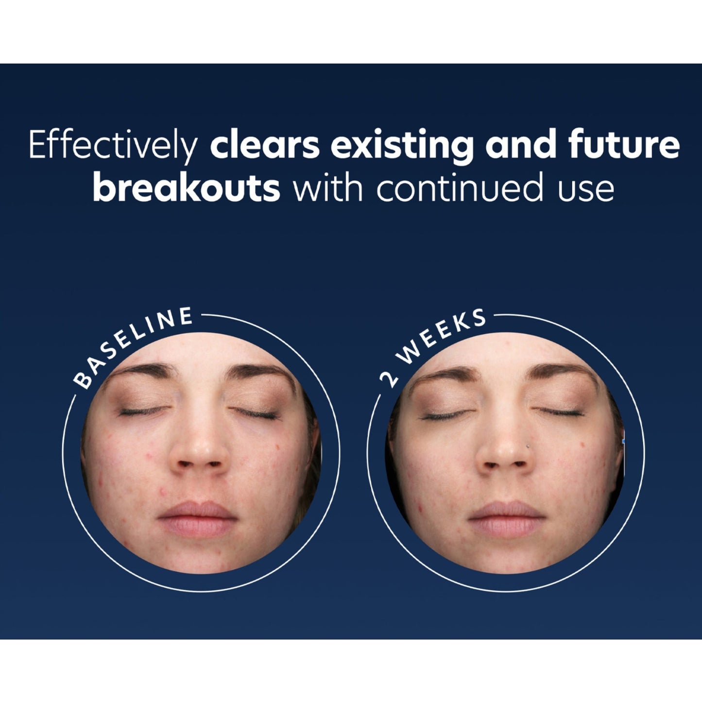 Acne Gel - Beautifox