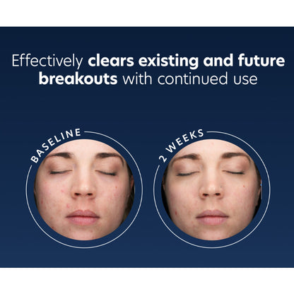 Acne Gel - Beautifox
