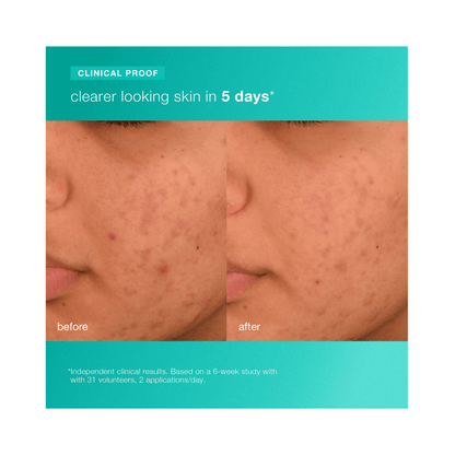 Dermalogica Acne Biotic Moisturizer - Beautifox