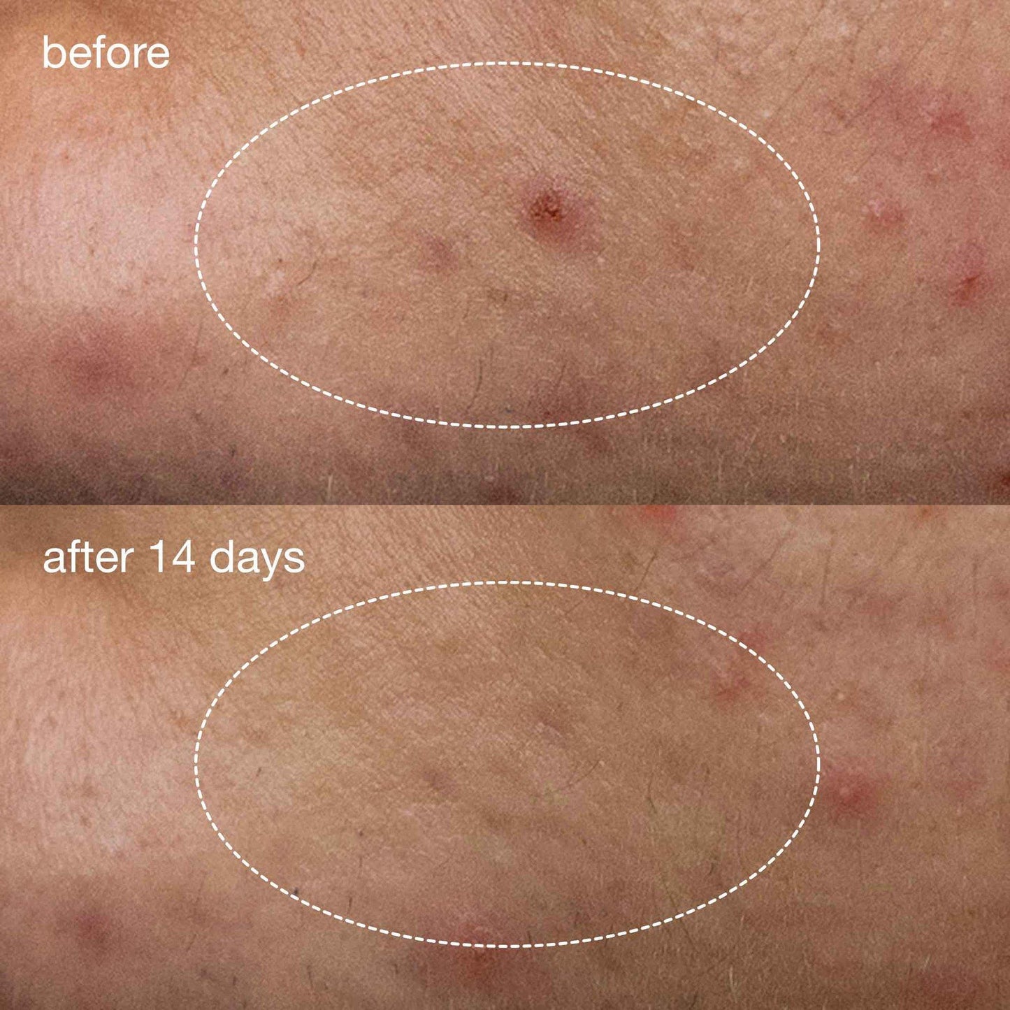 Dermalogica Deep Acne Liquid Patch - Beautifox