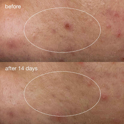 Dermalogica Deep Acne Liquid Patch - Beautifox