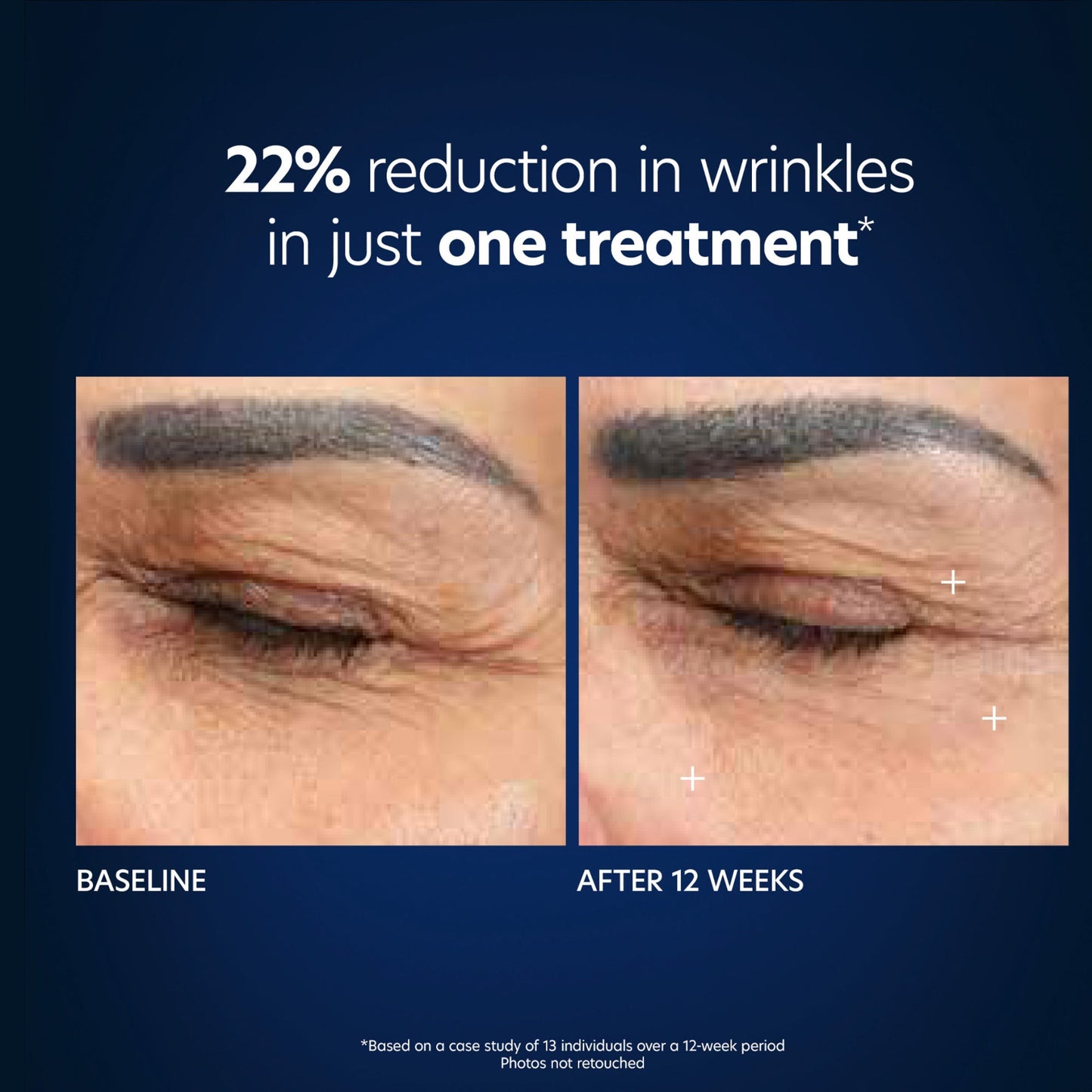 Hyaluronic Acid Microneedle Eye Patches - Beautifox