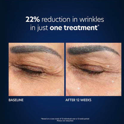 Hyaluronic Acid Microneedle Eye Patches - Beautifox