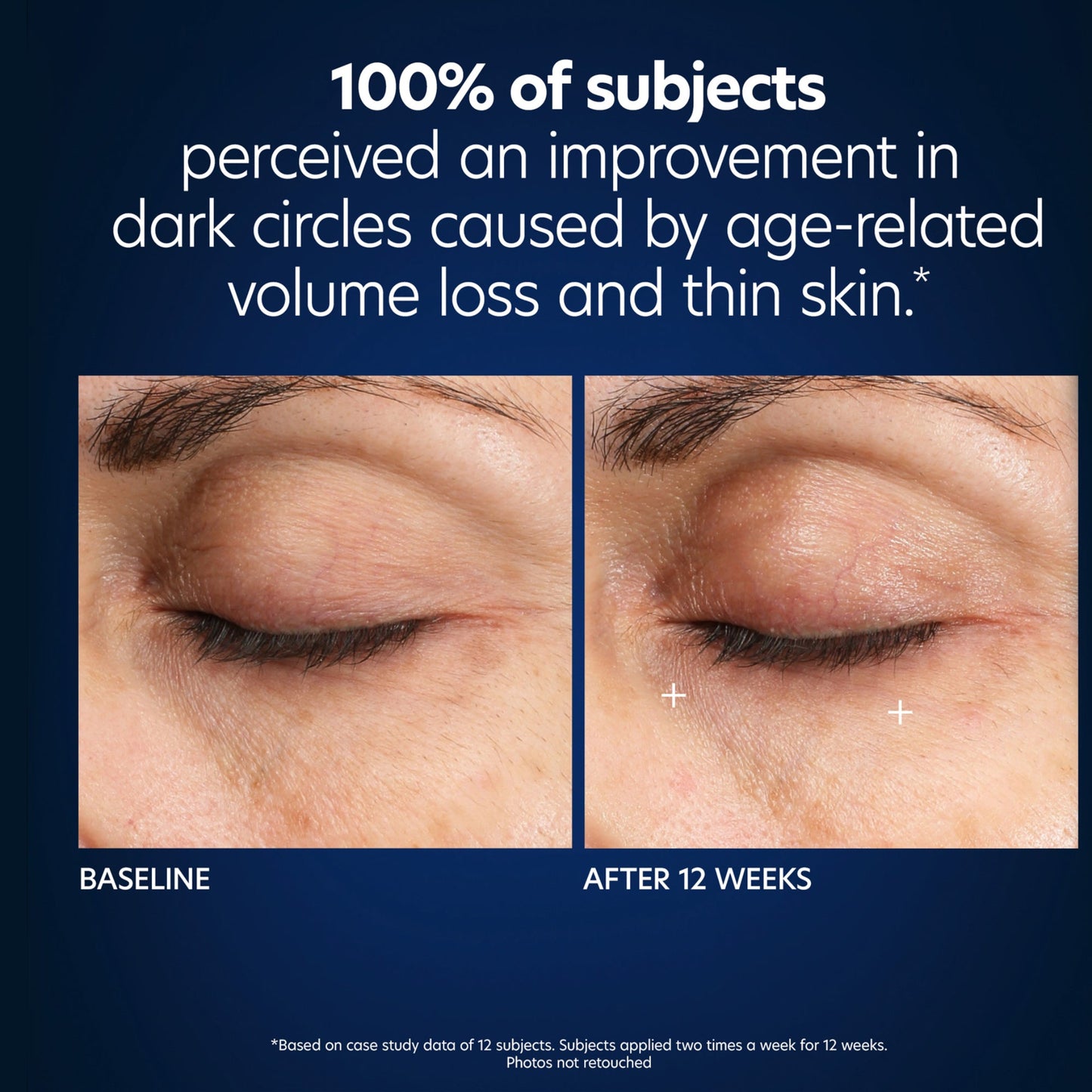 Hyaluronic Acid Microneedle Eye Patches - Beautifox