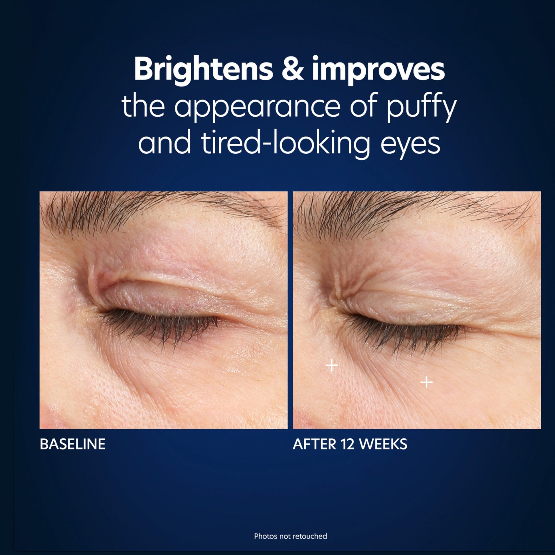 Hyaluronic Acid Microneedle Eye Patches - Beautifox